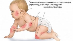 Különösen az atópiás dermatitis Komarovka okoz, tünetei, kezelése