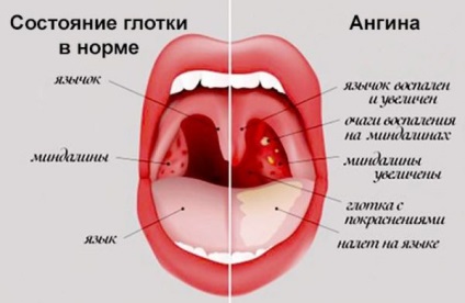 Umflarea gâtului cu angina ce trebuie făcută, cum să eliminați, decât să tratezi