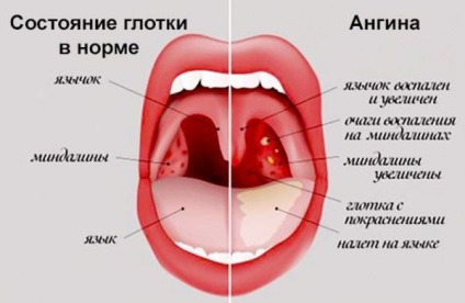 Gégeödémát angina, mit kell tenni, hogyan kell eltávolítani, mint a gyógyítás