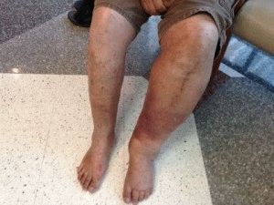 Edemul picioarelor după inflamația erisipelatoasă a formei bolii, tratamentul, prevenirea