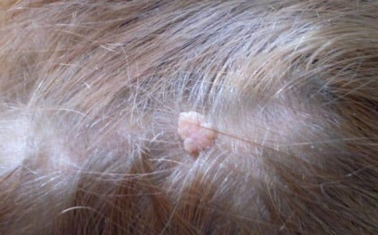 Papilloma pe cap în fotografie de păr, îndepărtarea, tratamentul