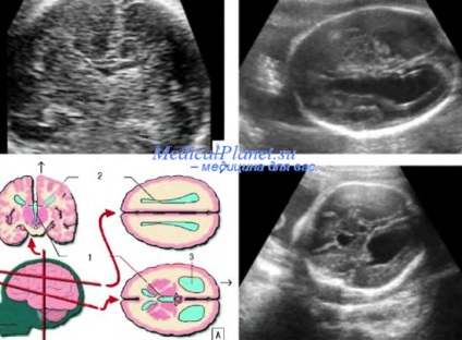 Patologia corpusului callos