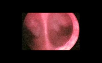 Patologia cavității uterine, polipi, sinechia, septul în uter