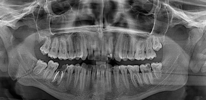 Fractura tratamentului maxilarului inferior, simptome și prim ajutor
