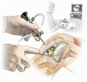 Leziuni menisci, ligamente cruciate, cartilaj articular al articulației genunchiului