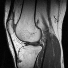 Leziuni menisci, ligamente cruciate, cartilaj articular al articulației genunchiului