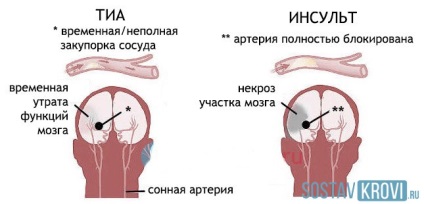 Predinsultnoe állapot tünetei, okai, mit kell tenni, a diagnózis és megelőzés