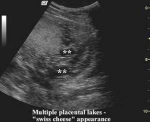 Nodul prenatal - diagnosticul creșterii placentei