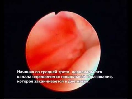 Okai összenövések a méhben és a kezelési módszerek (orális) Az okok a letapadás kialakulását az üregben a méh és a kezelések