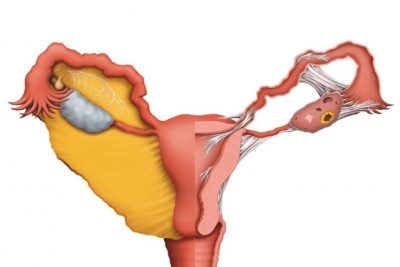 Motivele pentru formarea synechia în cavitatea uterină și metodele de tratament