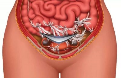 Причините за формирането на сраствания в кухината на матката и лечения
