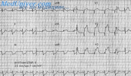 Exemplu de infarct miocardic recurent