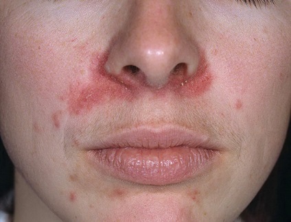 Despre dermatită și cum să ameliorați pruritul cu dermatită