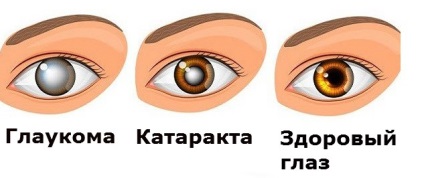 Megelőzése figyelmezteti a glaukóma betegség előfordulása (előfordulása) Megelőzés glaukóma mind meggátolja a betegség