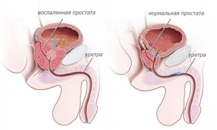 Funcțiile de bază ale prostatei și bolile glandei