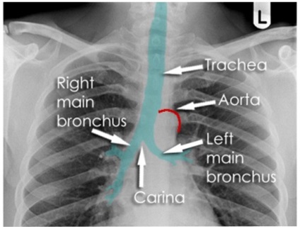 Radiografia indicației traheale, comportament, rezultate