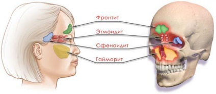 Sifenoidita simptome și tratament, diagnostic, cum să tratăm