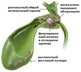 Sindromul oglindelor