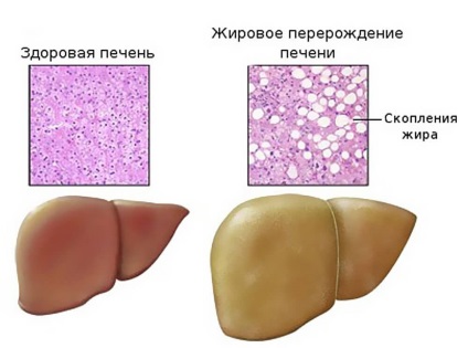 Steatoza cauzata de ficat, simptome, diagnostic si tratament