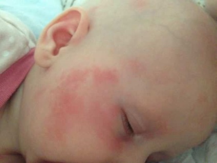 Száraz bőr, vörös foltok és más bőrbetegségek csecsemők