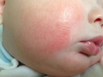 Száraz bőr, vörös foltok és más bőrbetegségek csecsemők