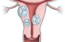 Descoperirea fibromyomului