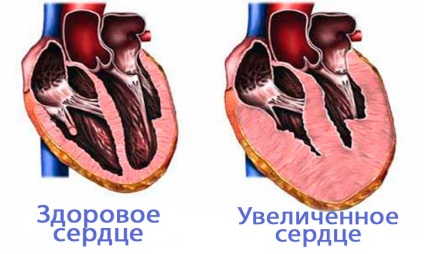 Creșterea inimii - cauze ale unui ventricul mare, tratament și consecințe pentru adulți și copii