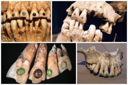 Ororile din stomatologia medievală, de la care veți înceta să vă temeți de medicul dentist - începutul