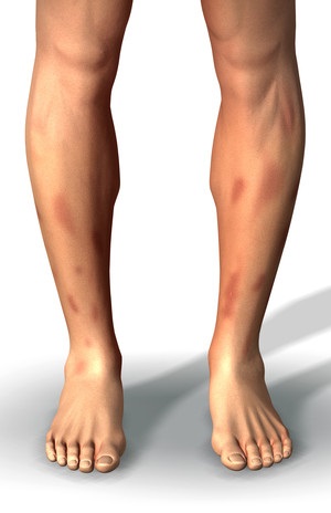 Erythema nodosum a lábát az okok és a betegség tünetei - nő s nap
