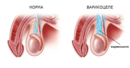 Varikotsele ce fel de diagnostic este, ce arată boala (foto atașat), codul micro-10 și, de asemenea,