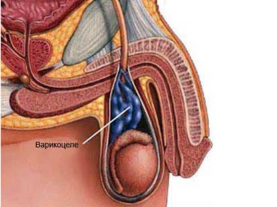 Varicocele milyen diagnózis külleme betegség (fotó mellékelve), a kód BNO-10, valamint a