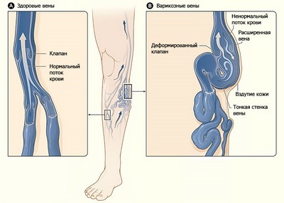 Varicozitatea - cauzele venelor varicoase - simptomele venelor varicoase - diagnosticul de vene varicoase