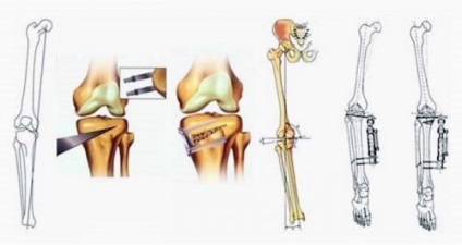 Deformarea vasculară a articulațiilor genunchiului