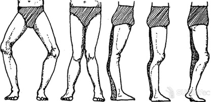 Deformarea vasculară a articulațiilor genunchiului la copii și adulți