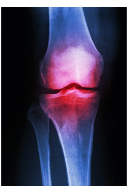 Deformarea vasculară a articulației genunchiului la copii