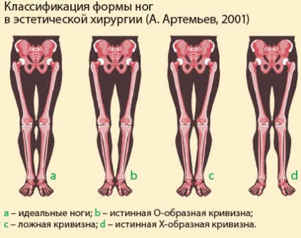 Deformarea vasculară a articulației genunchiului la copii