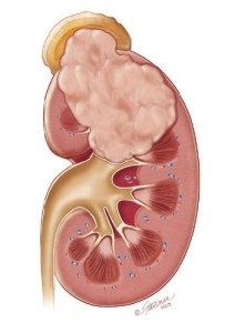 Malign tumoră hiperfrenică a cancerului de rinichi