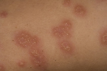 Viszkető dermatosis példák kórfolyamatában és kezelésében