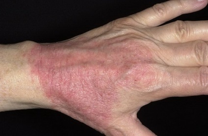 Viszkető dermatosis példák kórfolyamatában és kezelésében