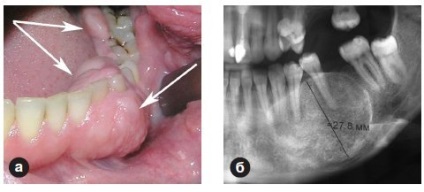 Ameloblastoma tünetek és a kezelés a mandibula