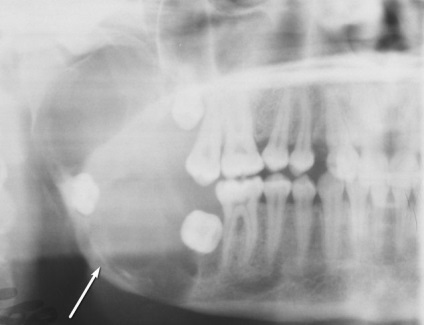 Ameloblastoma tünetek és a kezelés a mandibula