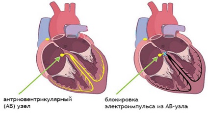 Aritmie ce este, cauze, simptome, diagnostic și tratament