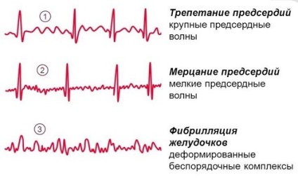 Aritmie ce este, cauze, simptome, diagnostic și tratament