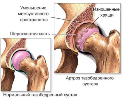 Osteoartrita articulației de șold (coxartroză) - cauze, tratament