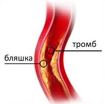Ateroscleroza aortei este ceea ce este să tratați simptomele