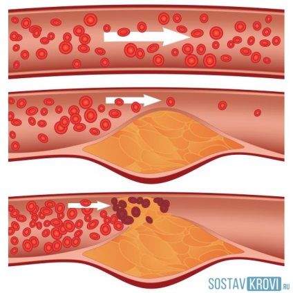 Ateroscleroza cauzelor aortei, simptome, localizare, diagnostic, tratament și dietă