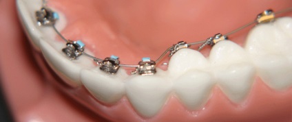 Nadrágtartók, telepítés konzolok Samara, az összehangolás a fogak fogszabályozó, fogorvosi
