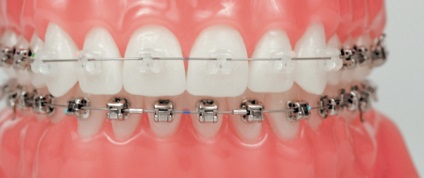 Paranteze, preturi pentru instalarea de paranteze in samara, alinierea dintilor de dinti, stomatologie