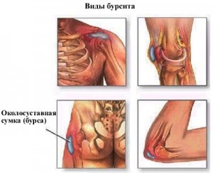 Bursita, tratamentul sinovitisului, prevenirea și fizioterapia