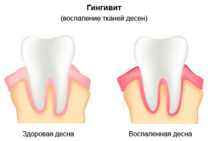 Ce trebuie făcut dacă copilul are un dinte stubby (permanent)